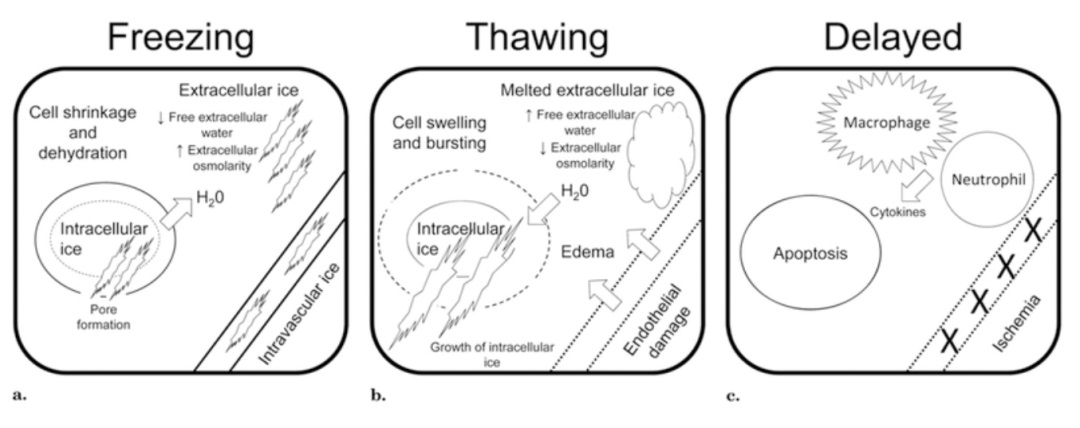 腫瘤治療界的「高冷之花」——腫瘤微創(chuàng)冷凍消融，國(guó)產(chǎn)替代設(shè)備空間巨大