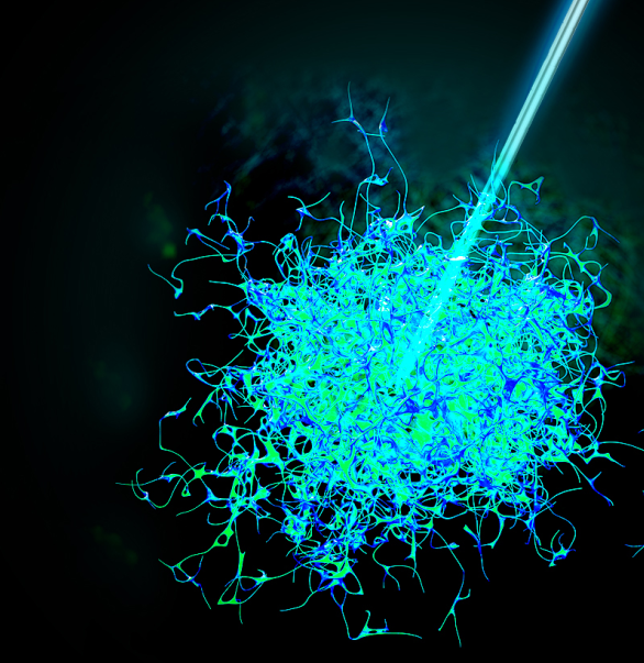 今天，我們把腫瘤的內(nèi)部「融穿」了